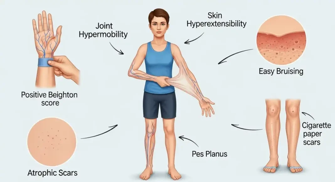 detailed medical illustration featuring ehlers-danlos syndrome signs